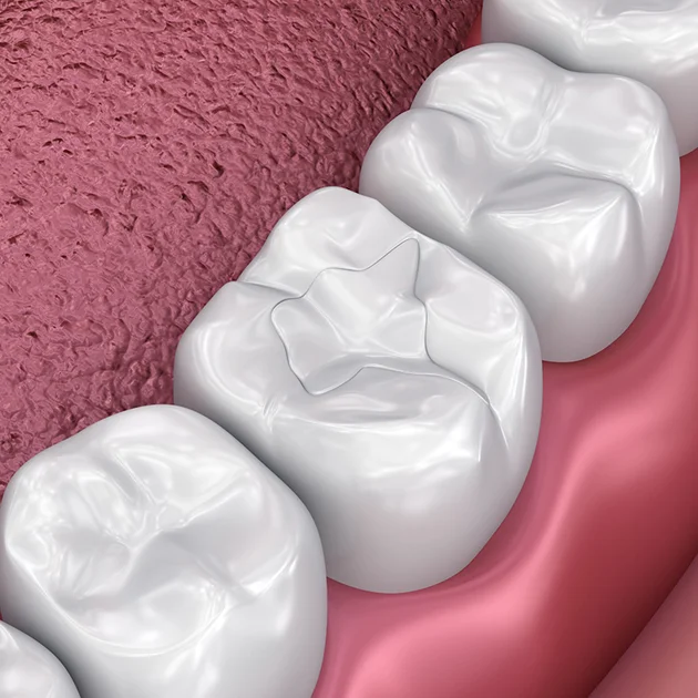 Three white dental crowns positioned on pink gum model showing restorative dentistry procedure.