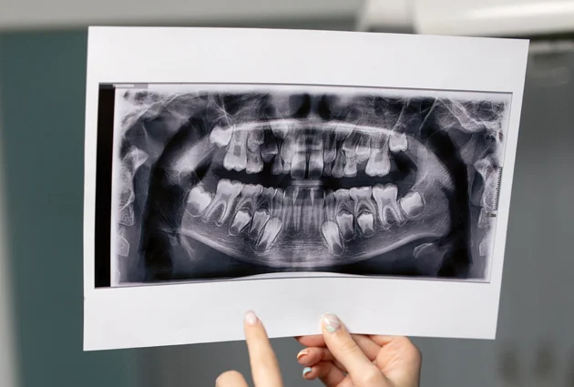 Hand holding panoramic dental X-ray showing full mouth teeth structure and jaw alignment.