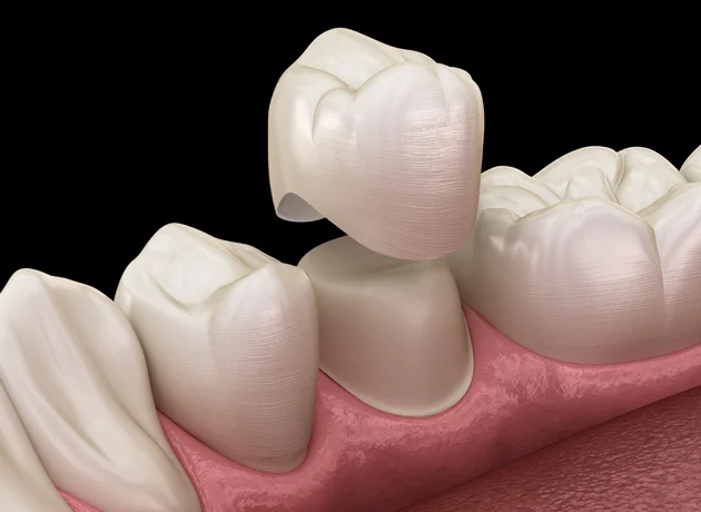 Dental crown placement illustration showing tooth preparation and ceramic crown restoration on gum model.