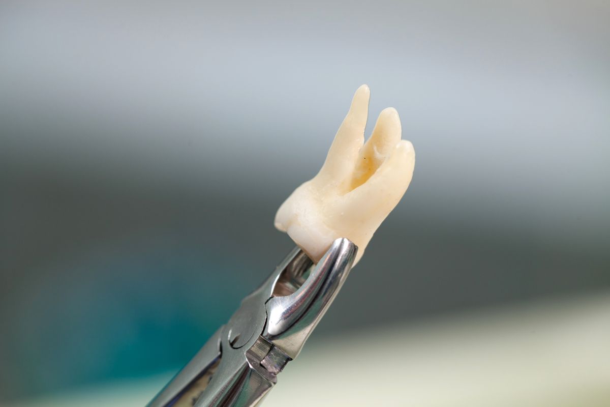 Tooth Extraction Aftercare