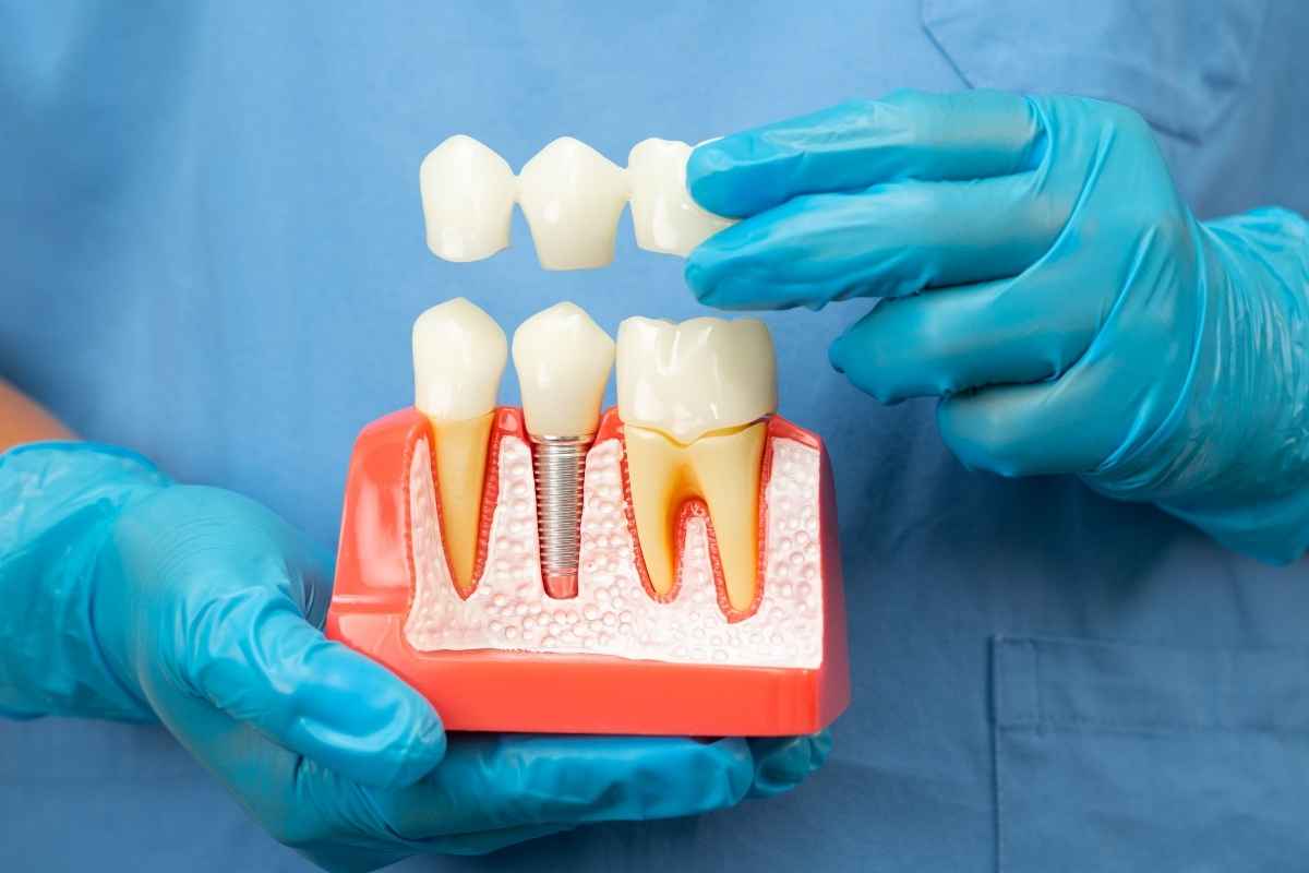 dental implant treatment