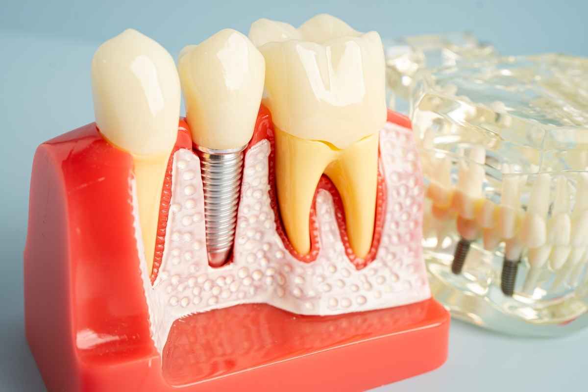 dental Implant treatment | Maryland Family & General Dentistry