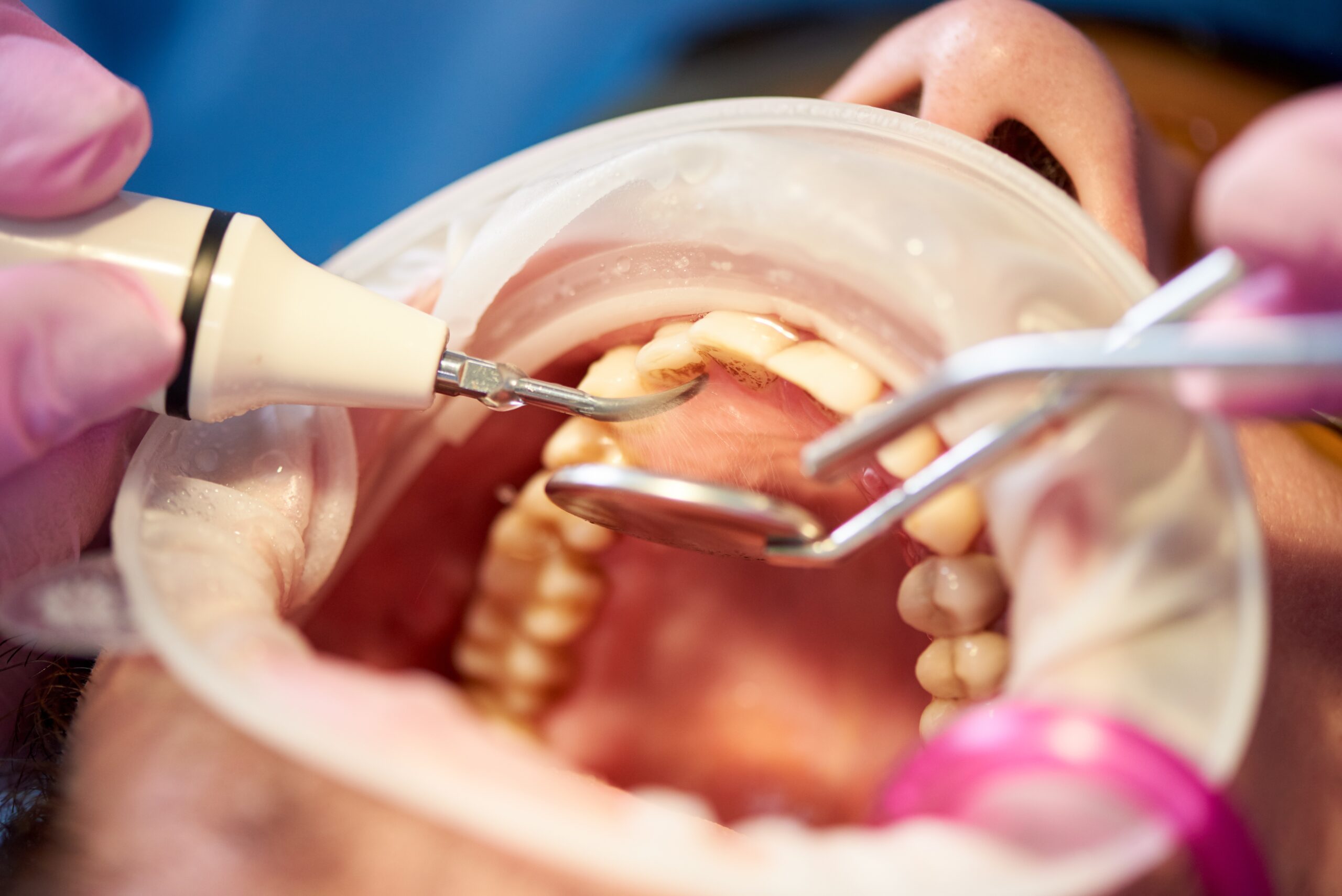 Teeth Whitening in Silver Spring